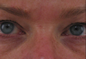After botox treatment in San Mateo, CA